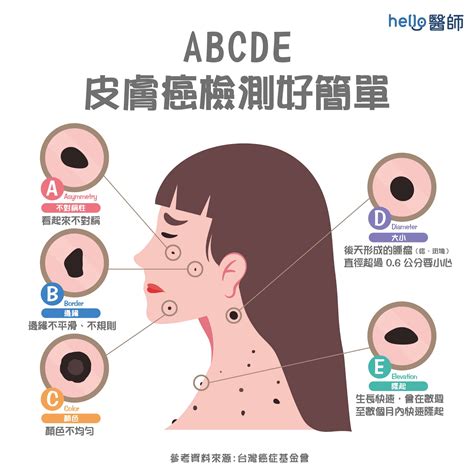 胸部長很多痣|痣形成的原因？痣長毛、痣變多變大是痣病變？5招判別